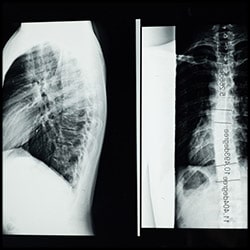 spine-scan
